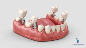 coronas de implantes
