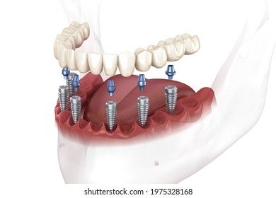 Diagrama didáctico del protocolo All-on-Six con seis implantes en mandíbula inferior