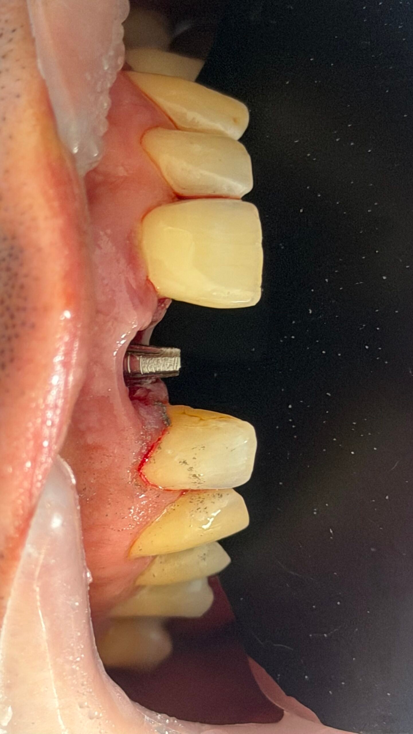 Control clínico intraoral de implante corticobasal individual