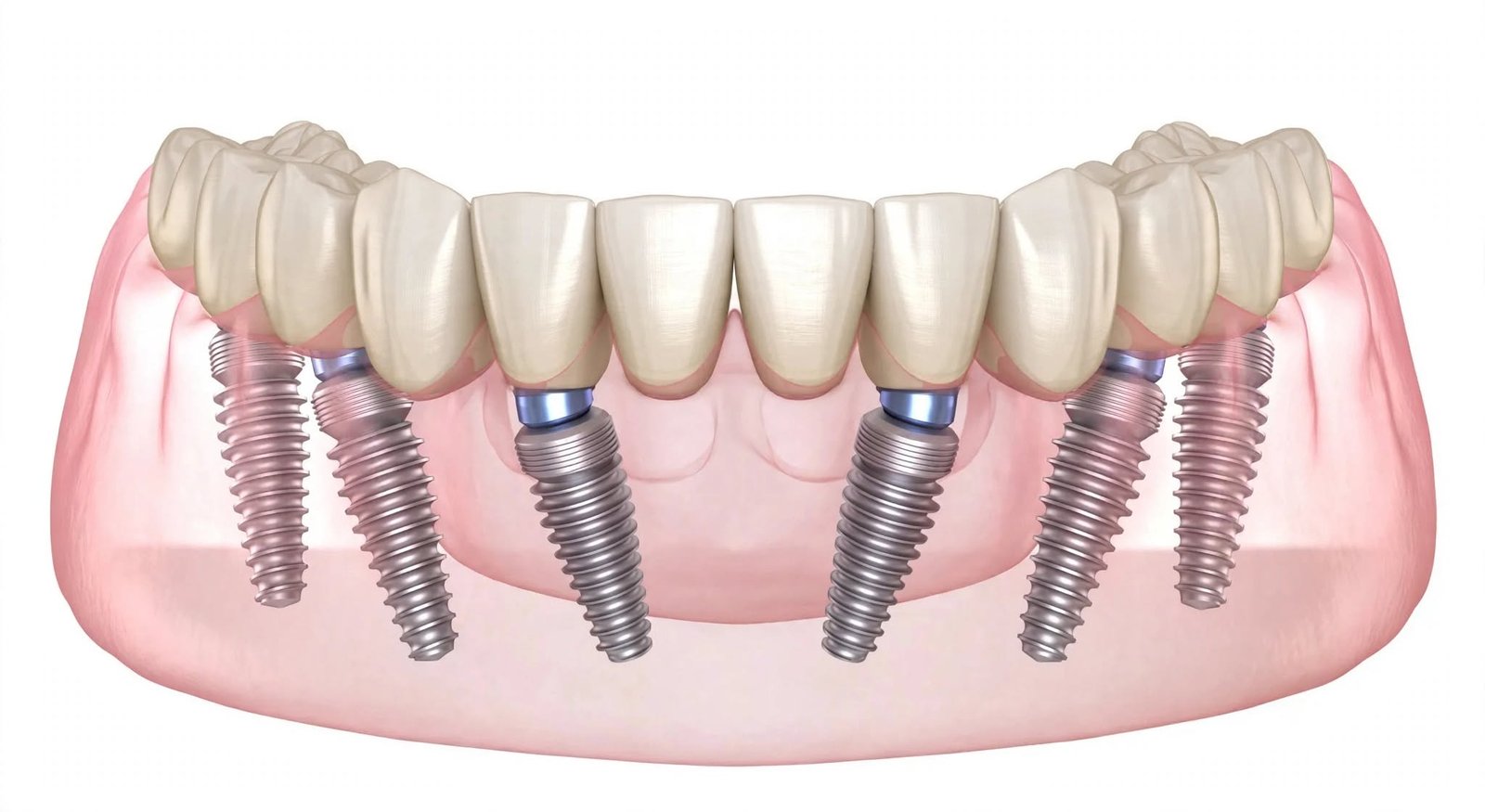 Diagrama de arcada dental completa con implantes soportando una rehabilitación fija superior e inferior