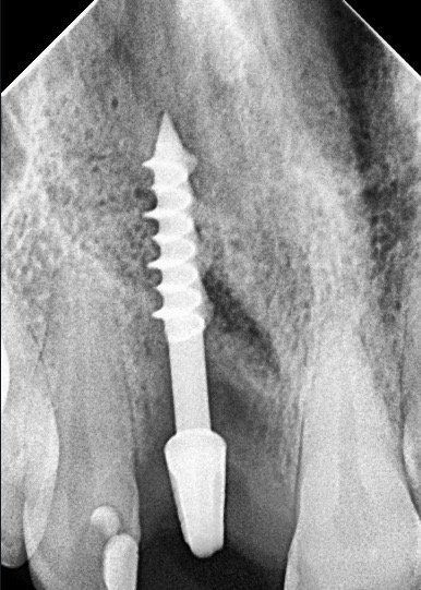Radiografía periapical de implante corticobasal individual